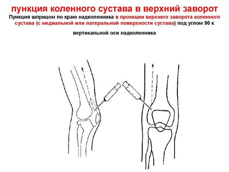 Когда можно обуваться после пункции коленного сустава