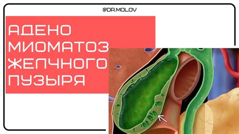 Когда нужна консультация врача: признаки осложнений приступа желчного пузыря