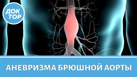 Когда нужно оперировать аневризму брюшной аорты: факторы риска и рекомендации