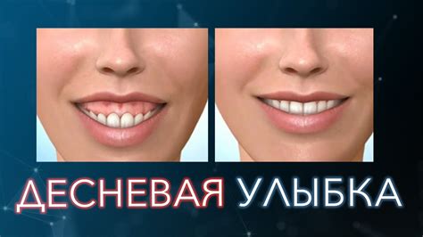 Коррекция недостатков улыбки с помощью ортодонтии