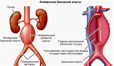 Критерии размера аневризмы брюшной аорты: больше – не всегда значит лучше