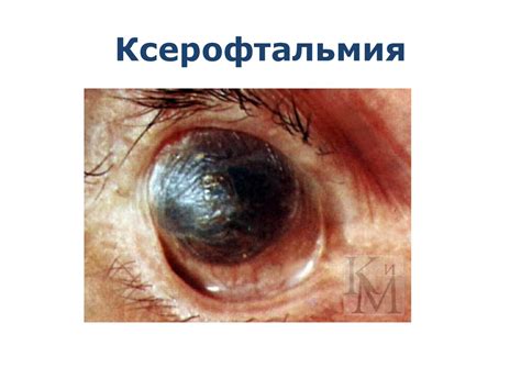 Ксерофтальмия и рахит