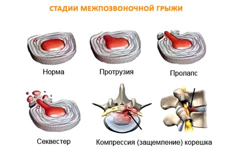 Кто может проводить массаж при межпозвоночной грыже