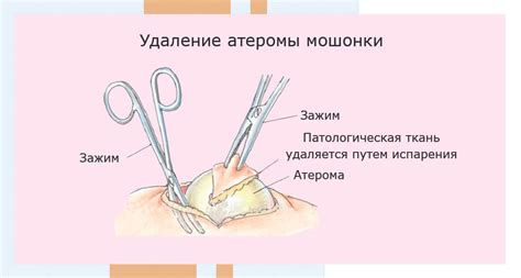 Лекарственные препараты для удаления атеромы