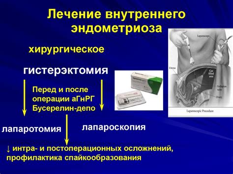 Лечение внутреннего падения органов
