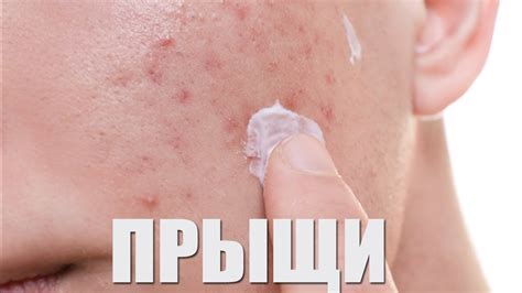Лечение и профилактика прыщей при приеме противозачаточных