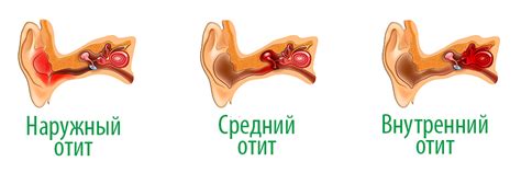 Лечение отита с помощью фитосвечей - преимущества и результаты