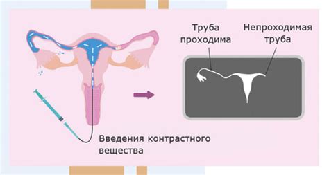 Медикаментозная диагностика: определение препятствий в маточных трубах