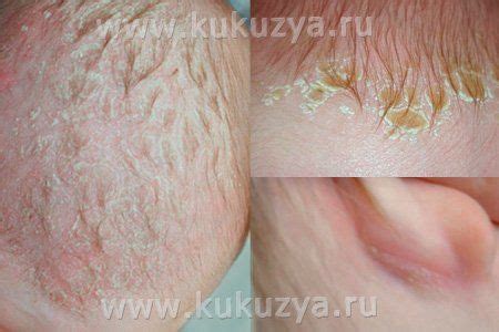 Медикаментозное лечение корочки на голове