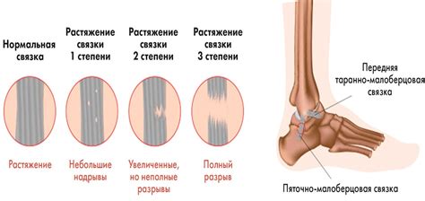 Медикаментозное лечение растяжения связок
