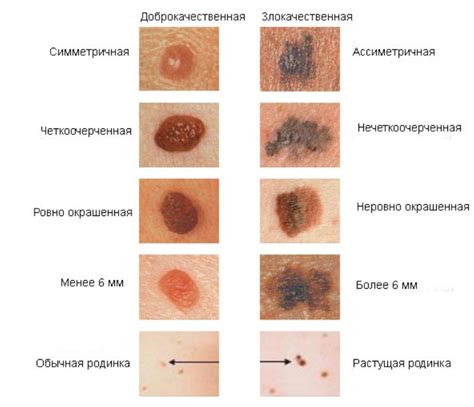 Медицинский взгляд на родинки: факты и исследования