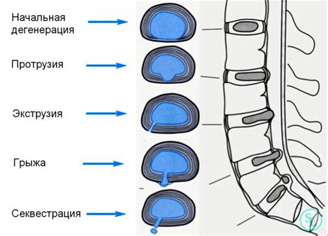 Межпозвоночная протрузия и ее признаки на рентгеновских снимках