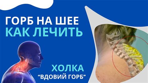 Методы для избавления от горба на шее