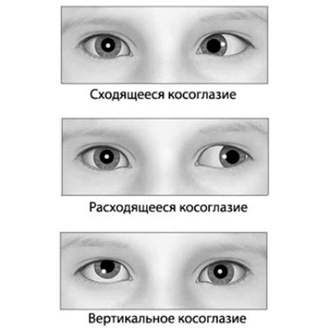 Методы коррекции косоглазия