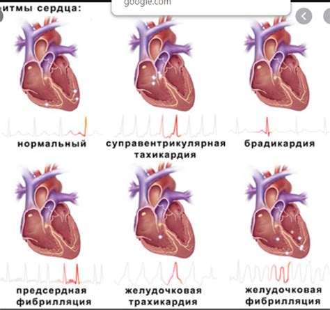 Механизмы возникновения одышки при тахикардии