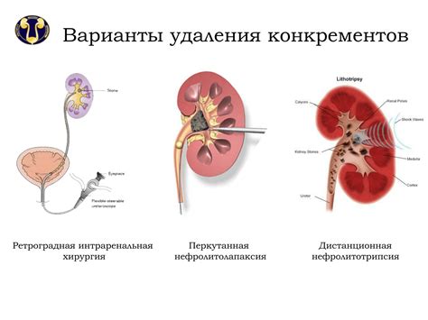 Механизм действия грелки на камни в почках