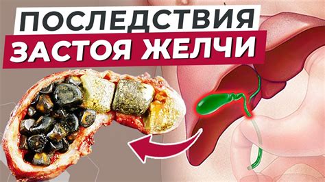 Мифы и факты о влиянии кофе на застой желчи