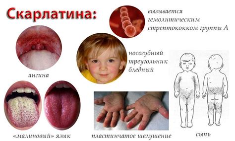 Можно ли убедиться в отсутствии скарлатины у ребенка