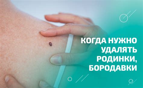 Можно ли удалять родинки во время грудного вскармливания