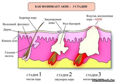 Научные исследования о связи между сахаром и прыщами