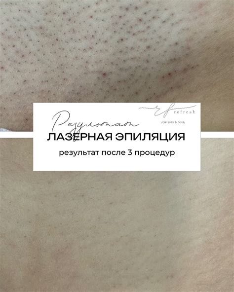 На каком этапе роста волос начинать лазерную эпиляцию