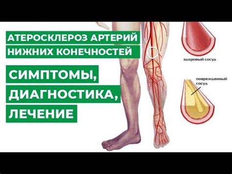 Невосприятие конечностей: симптомы
