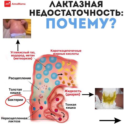 Непереносимость лактозы у детей
