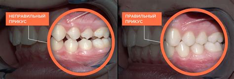 Неправильное положение зубов