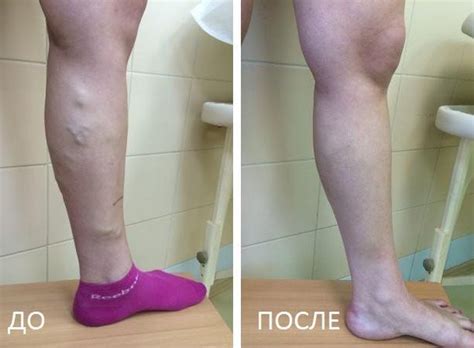 Ограничения по ношению каблуков после процедуры склеротерапии