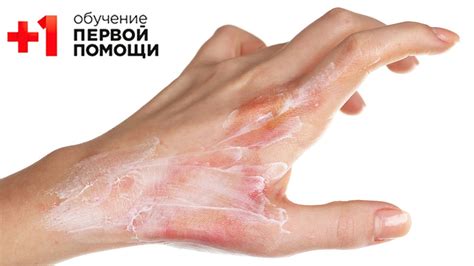 Ожоги и пузыри: рекомендации и последствия