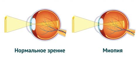 Окулистическое ухудшение зрения