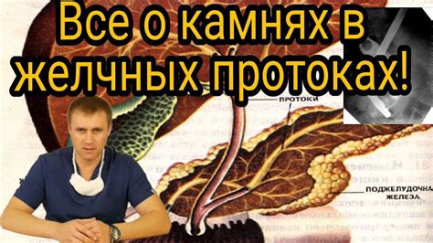 Опасности образования камней после удаления желчного пузыря