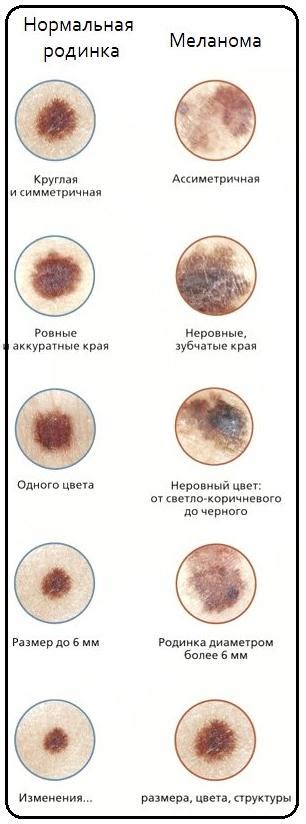 Опасность меланомы