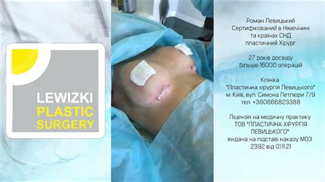 Операция увеличения груди: продолжительность реабилитации