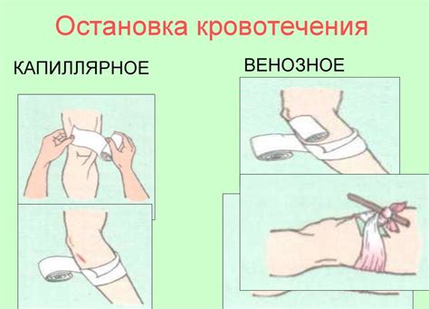 Описание ситуаций, требующих применение давящей повязки