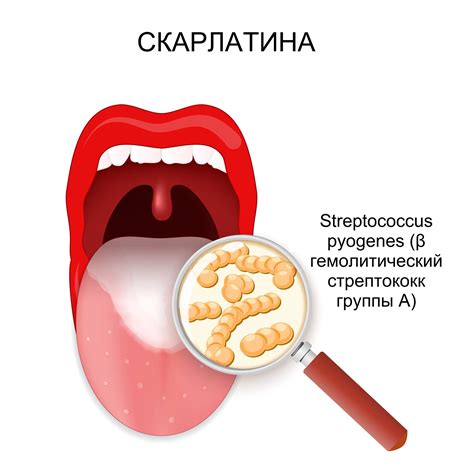 Оптимальное время гуляния при скарлатине