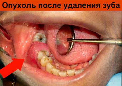 Опухоль после удаления флюса: симптомы