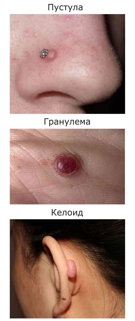 Осложнения после зарастания прокола в носу