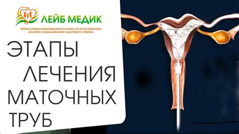 Основные показания для проведения лапароскопии маточных труб
