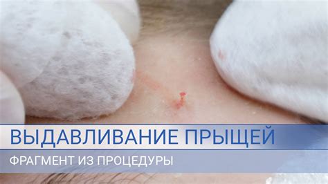 Основные правила выдавливания прыщей
