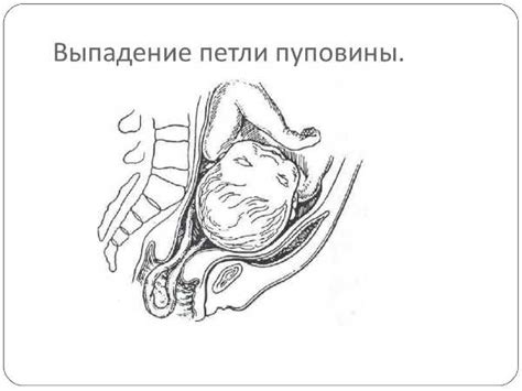 Основные рекомендации в случае прокола пузыря без схваток