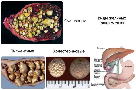 Основные симптомы движения камней