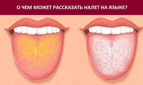 Основные способы удаления желтого налета на языке