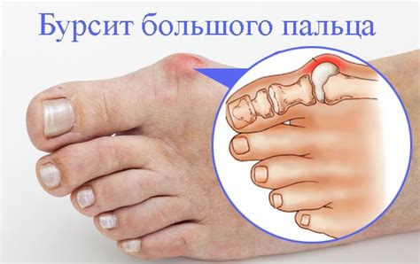 Особенности заклеивания пальца ноги