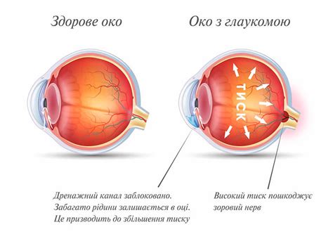 Особенности операции по лечению глаукомы