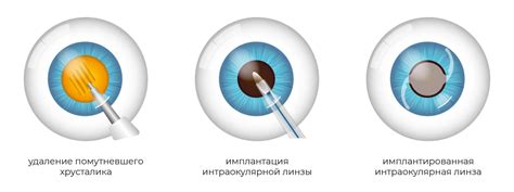 Особенности операции по удалению глаза