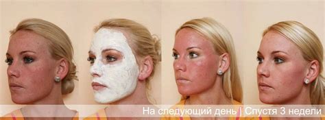 Особенности процедуры пилинга джесснера в летний период