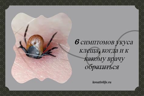 Остальные характеристики укуса клеща