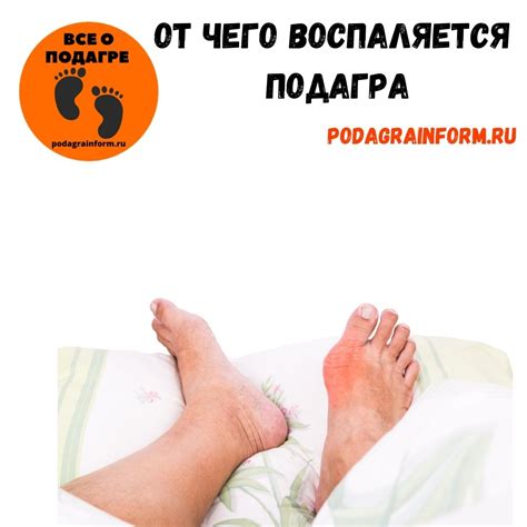 Отек стоп при подагре: причины и лечение