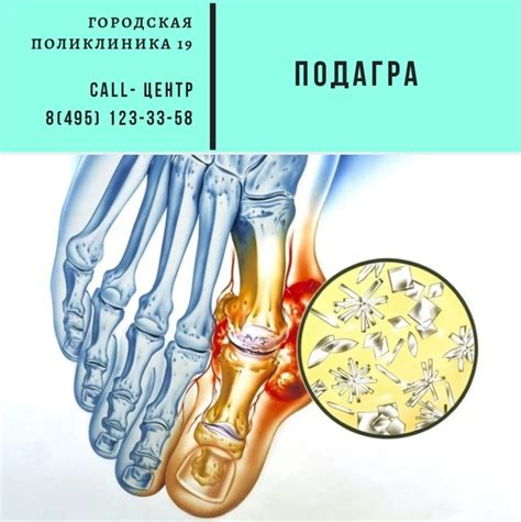 Отложение солей и подагра